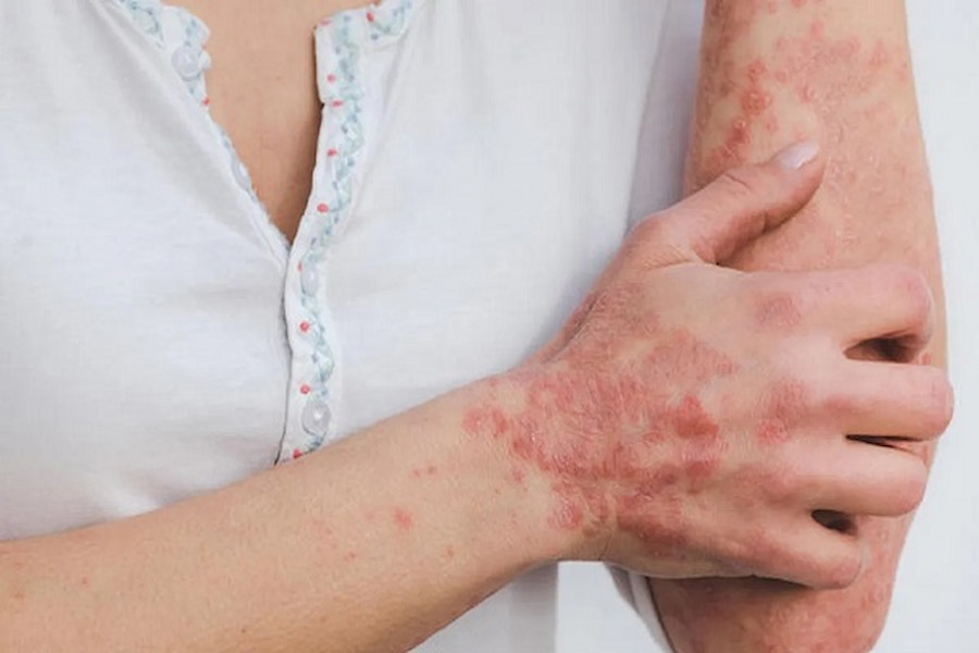 انتقال قارچ از گربه به انسان